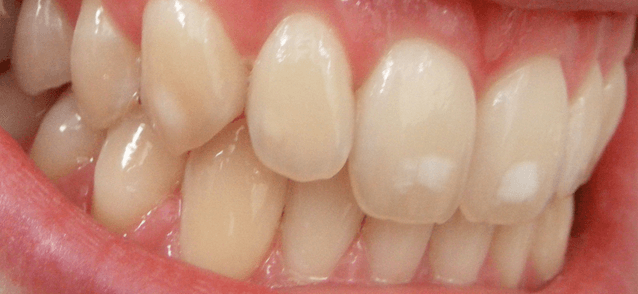 Лечение флюороза зубов
